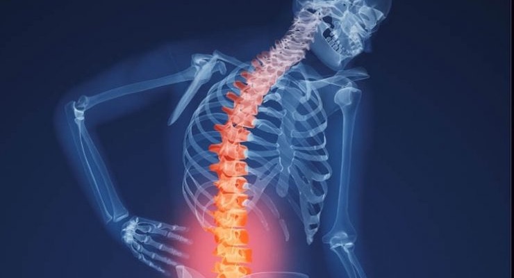 Osteoporosis: Symptoms, Causes and Treatment